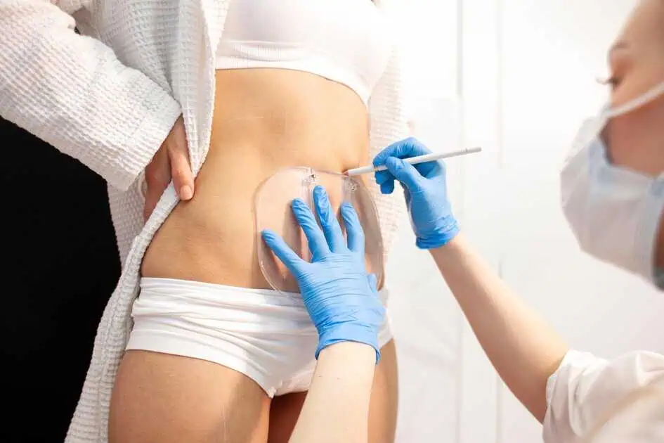 CoolSculpting in Vestavia Hills, AL by PETRO FACIAL PLASTIC SURGERY
